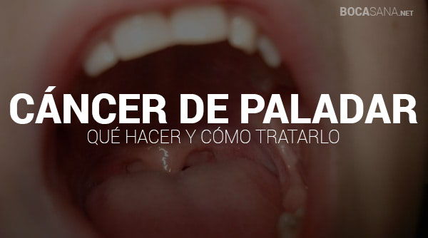Cáncer de Paladar