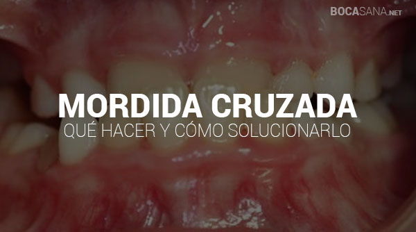 ¿Mordida Cruzada? 【Causas, Consecuencias y Cómo Corregirlo】