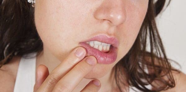 herpes y paladar amarillo