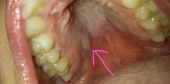 causas paladar blanco