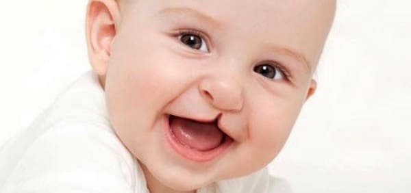 paladar hendido labio leporino