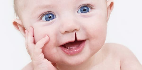 que es el labio leporino