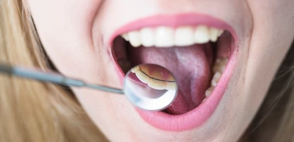 curar el paladar inflamado