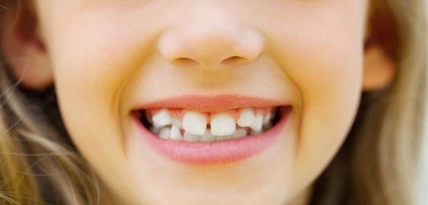 consecuencias del paladar ojival