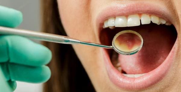 tipos de quemadura de paladar