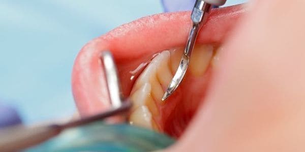 curetaje dental piorrea