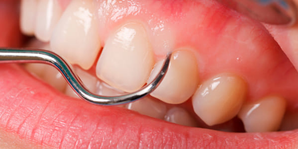 curetaje dental periodontitis