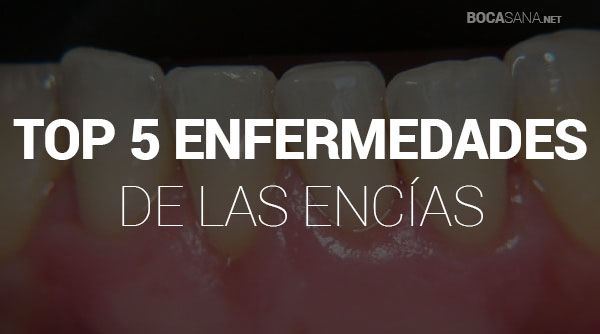 Enfermedades de las Encías