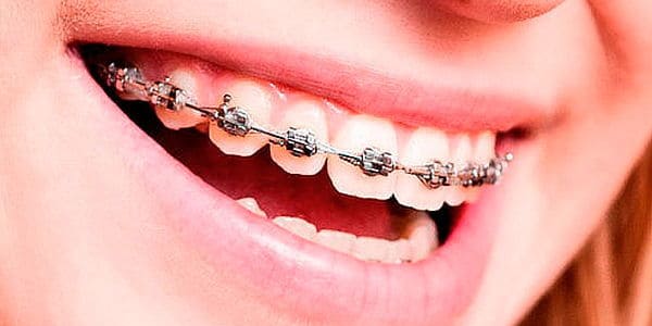 corregir la sobremordida