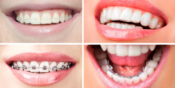 sobremordida adultos