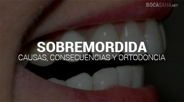 ¿Sobremordida? 【Causas, Consecuencias y Cómo Corregirlo】