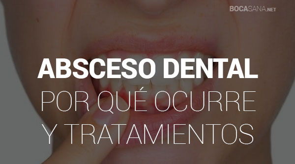 ¿Sufres de Absceso Dental? 【Causas, Síntomas y Tratamientos】