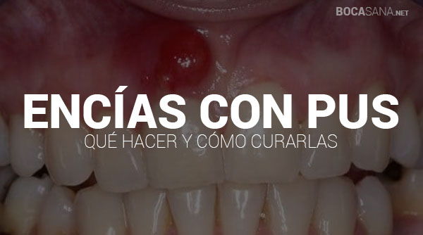 ¿Tienes Encías con Pus? Causas y Tratamientos 【2025 】