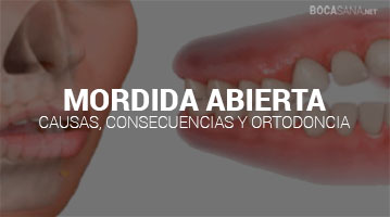 Mordida Abierta