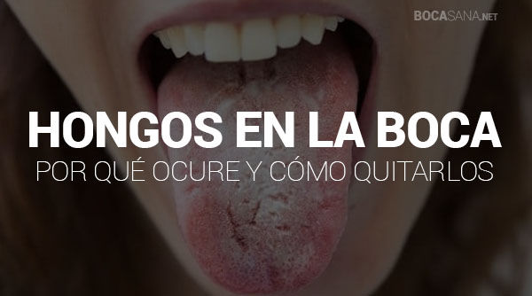 ¿Tienes Hongos en la Boca? 【 Síntomas, Causas y Tratamiento 】