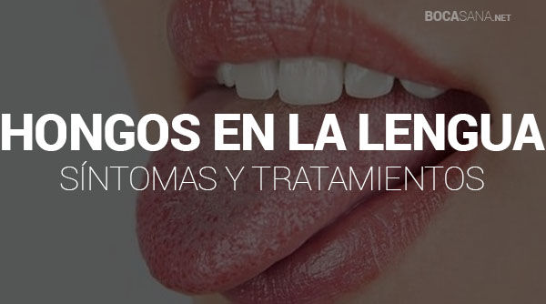 ¿Tienes Hongos en la Lengua? 【 Síntomas, Causas yTratamiento 】
