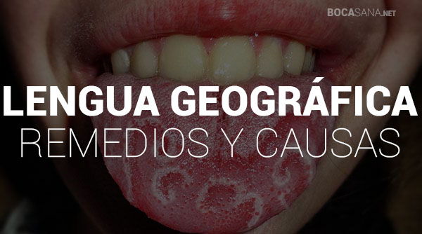 ¿Tienes la Lengua Geográfica? 【 Conoce Sus Causas y Remedios 】