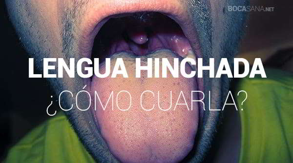 ¿Tienes la Lengua Hinchada? 【 Por Qué Ocurre y Cómo Curarla 】