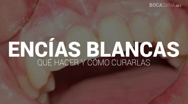 ¿Tienes las Encías Blancas? Causas y Tratamientos【2025 】
