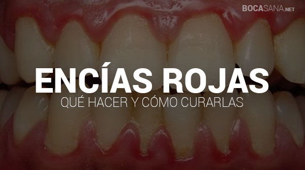 ¿Tienes las Encías Rojas? Causas y Tratamientos【2025 】