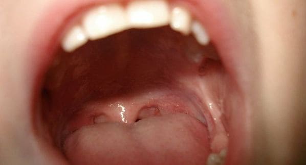 llagas en la garganta como curar