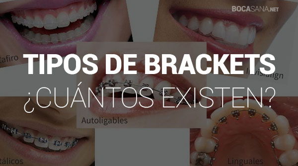 Tipos de Brackets que Existen en la Ortodoncia 【 2025 】