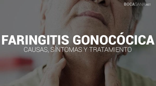 Faringitis Gonocócica