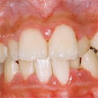 Gingivitis