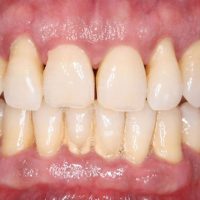 Periodontitis