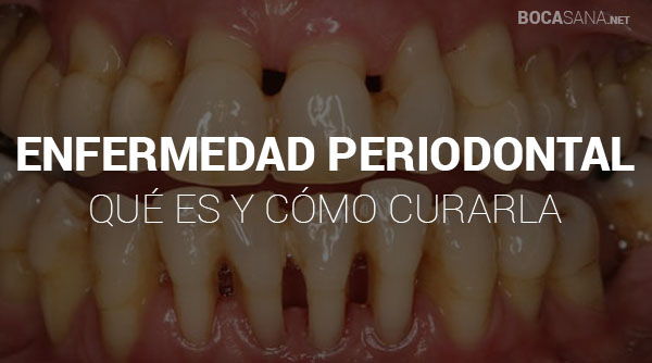 Enfermedad Periodontal