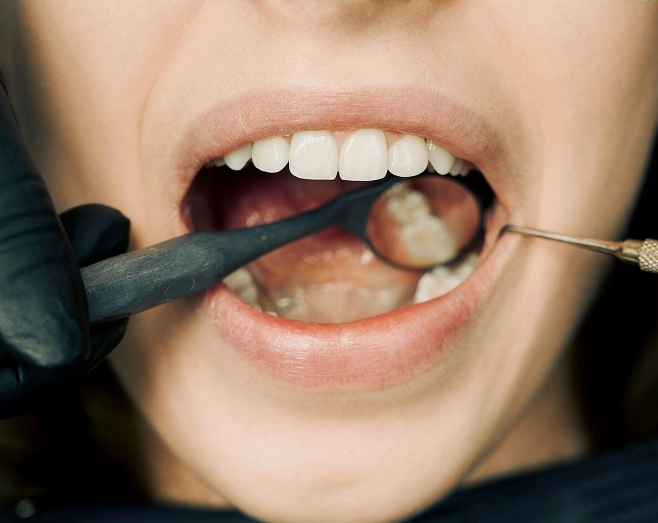 ¿Cómo puedo eliminar las manchas oscuras en las encías? - Salud dental