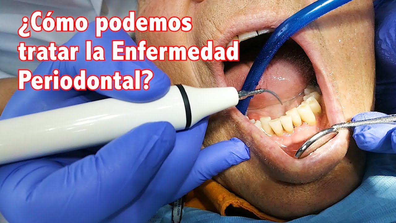 ¿Cómo curar la periodontitis?