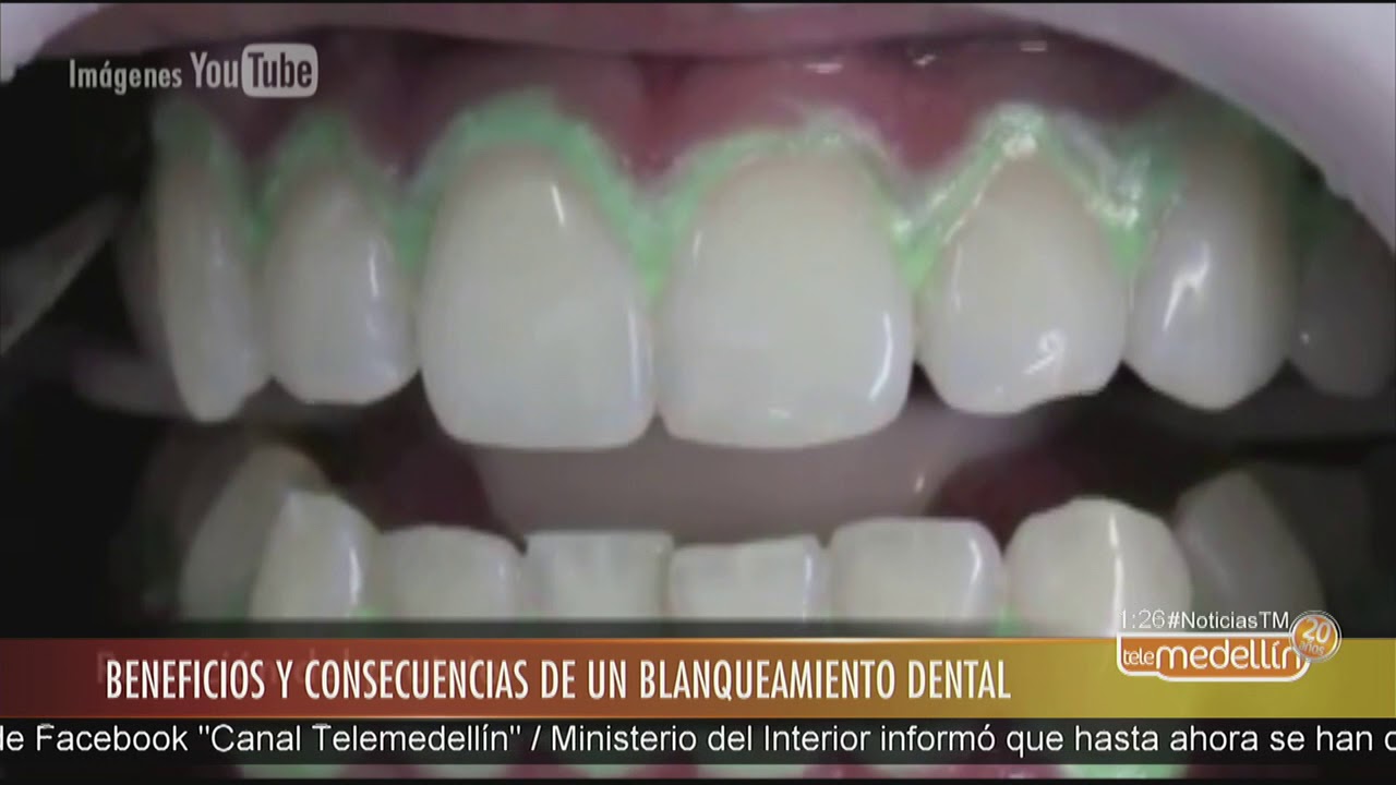 Contraindicaciones del blanqueamiento dental: ¿En qué casos no debemos hacérnoslo?